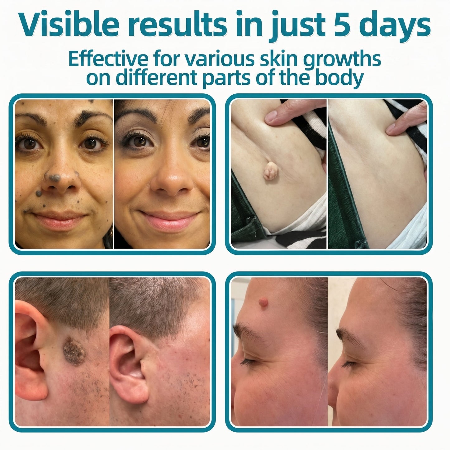 💞💞🇬🇧𝐇𝐞𝒂𝒍𝗿𝗶𝙯𝙚®2-in-1 Microneedle & Hydrocolloid Patch🛡️| Removes Raised Moles, Acne, Flat Warts & Skin Tags | Helps Improve Wrinkles, Scars & Blemishes | Invisible Patches for Face & Body