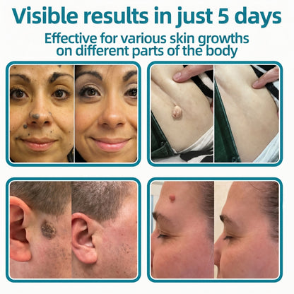 💞💞🇬🇧𝐇𝐞𝒂𝒍𝗿𝗶𝙯𝙚®2-in-1 Microneedle & Hydrocolloid Patch🛡️| Removes Raised Moles, Acne, Flat Warts & Skin Tags | Helps Improve Wrinkles, Scars & Blemishes | Invisible Patches for Face & Body
