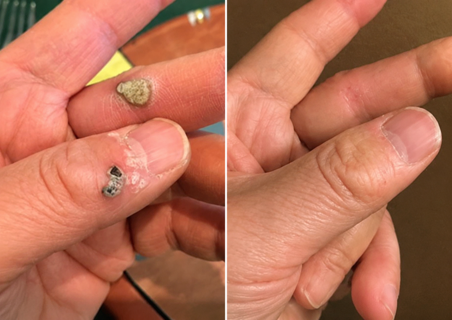 💞💞🇬🇧𝐇𝐞𝒂𝒍𝗿𝗶𝙯𝙚®2-in-1 Microneedle & Hydrocolloid Patch🛡️| Removes Raised Moles, Acne, Flat Warts & Skin Tags | Helps Improve Wrinkles, Scars & Blemishes | Invisible Patches for Face & Body